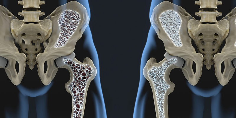 Image representing Osteoporosis Care and Bone Health