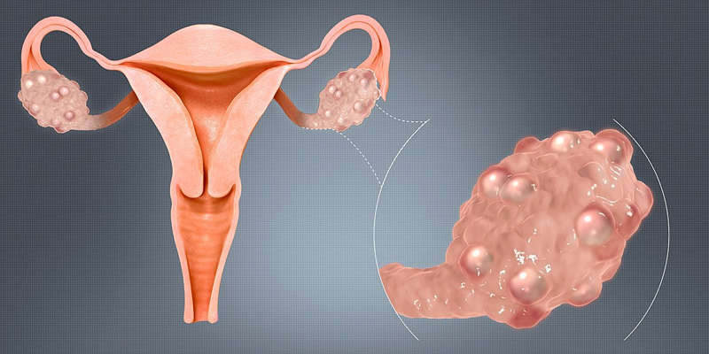 Image representing PCOS and Reproductive Endocrinology Care